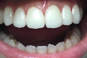 A person mouth showing a set of teeth after a treatment