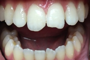 A person mouth showing a set of teeth before a treatment