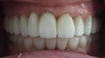 A person mouth showing a set of teeth after a treatment