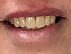 close up of woman's teeth after receving dental treatment to make teeth the same size