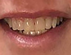close up of woman's teeth smiling that are heavily stained